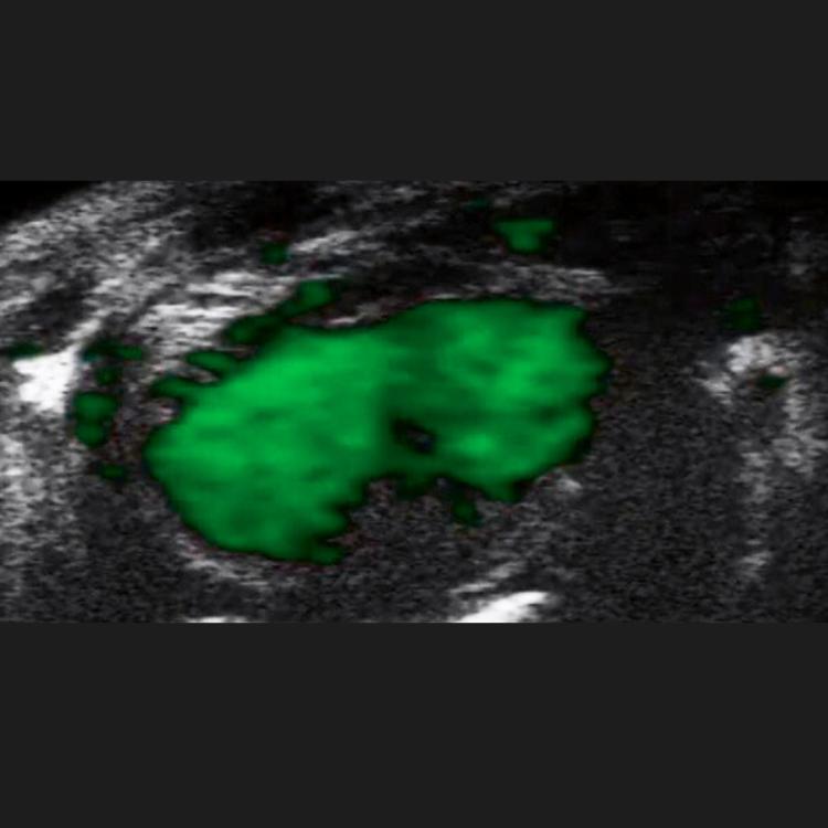 Ultrasound Contrast Agents