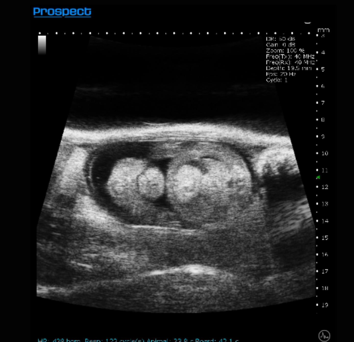 Prospect T2 Ultrasound